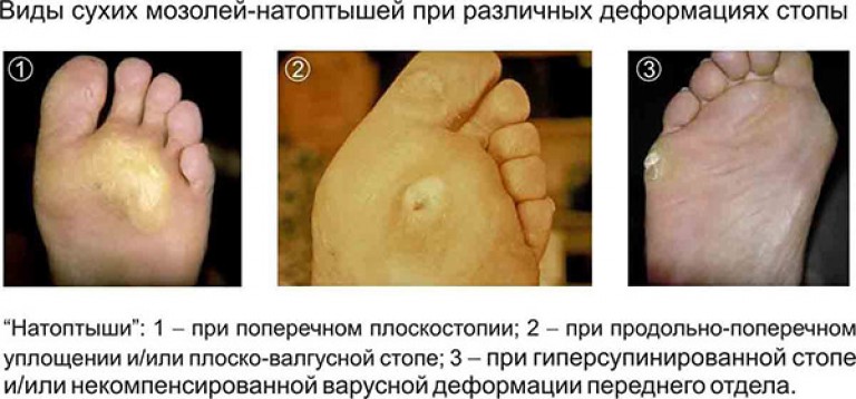 Как убрать стержневую мозоль в домашних условиях Как убрать стержневую мозоль в домашних условиях