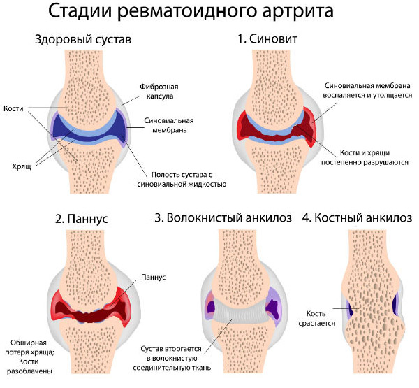 Как лечить суставы ног при ревматизме Как лечить суставы ног при ревматизме