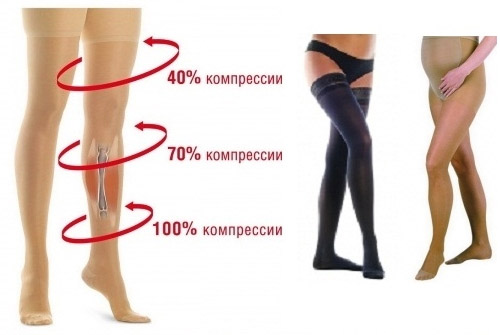 Сильный варикоз на ногах лечение