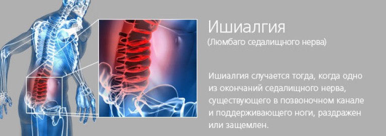 Боль в ягодице справа отдающая в ногу как лечить Боль в ягодице справа отдающая в ногу как лечить