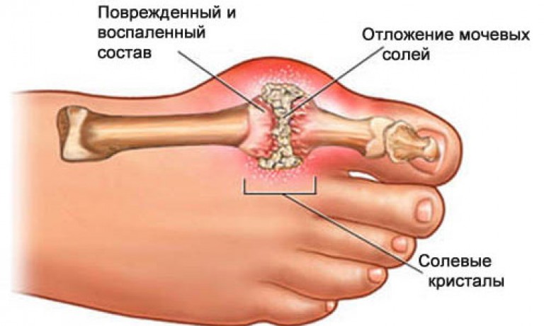 Остеохондроз турмалиновый пояс Остеохондроз турмалиновый пояс