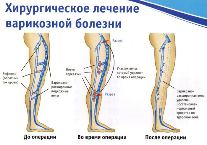 Какие есть мази от варикоза вен на ногах
