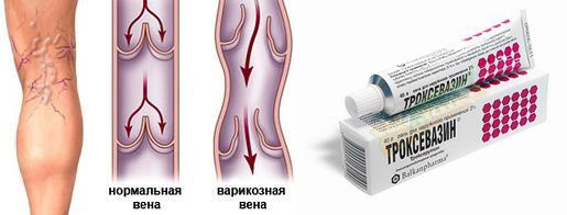 Мази для лечения вен на ногах