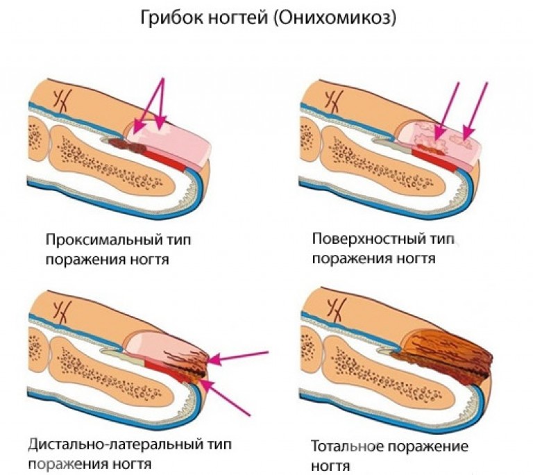 Мазь для лечить грибок ногтей на руках
