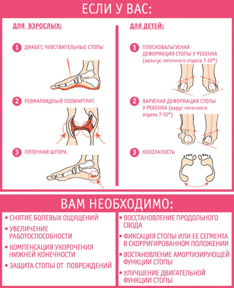 Ортопедические стельки при вальгусной деформации большого пальца у ...