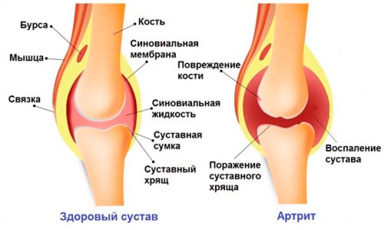 Синовиальный сустав позвоночника Синовиальный сустав позвоночника