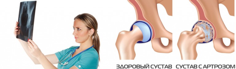 С чего начать лечить суставы С чего начать лечить суставы