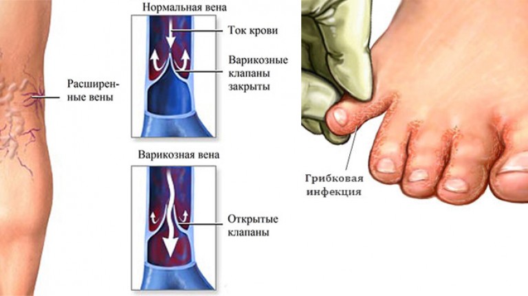 Как лечить боль в стопах при сахарном диабете 156