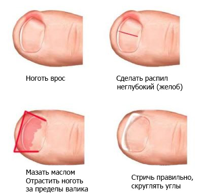 Удаление ногтя у грудничков Удаление ногтя у грудничков