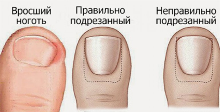 Как парить вросший ноготь Как парить вросший ноготь