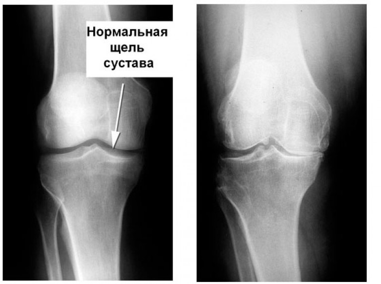 Гонартроз коленного сустава на рентгене Гонартроз коленного сустава на рентгене