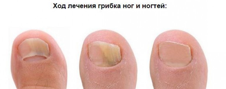 Лечение грибка на ногте ноги Лечение грибка на ногте ноги