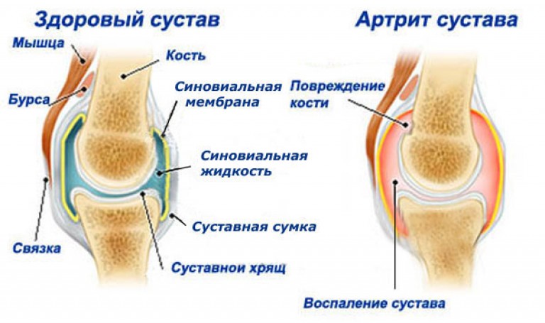 Токсический гепатит контрацептивы