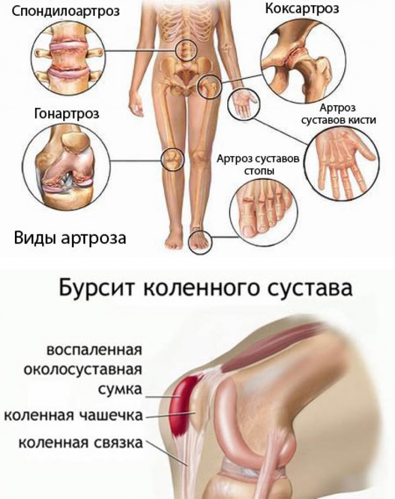 Артроз тазобедренных суставов к какому врачу обратиться Артроз тазобедренных суставов к какому врачу обратиться