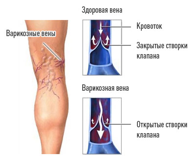 Симптомы нарушения кровообращения нижних конечностей и способы лечения, меры профилактики Симптомы нарушения кровообращения нижних конечностей и способы лечения, меры профилактики