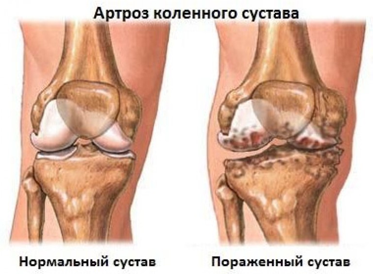 Диартроз суставов Диартроз суставов
