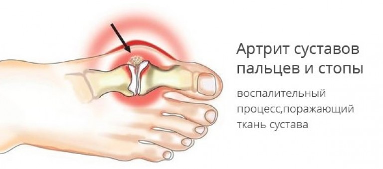 Как и чем лечить артроз стопы в домашних условиях Как и чем лечить артроз стопы в домашних условиях