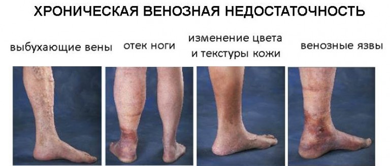 Хроническая венозная недостаточность как лечить Хроническая венозная недостаточность как лечить