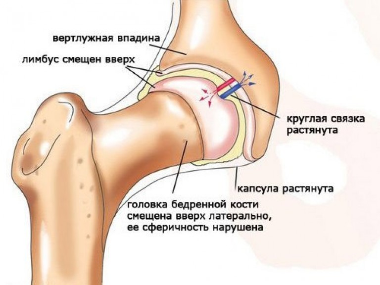 Подвывиха тазобедренного сустава Подвывиха тазобедренного сустава