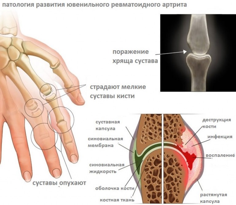 Остеохондроз и сердечное давление Остеохондроз и сердечное давление