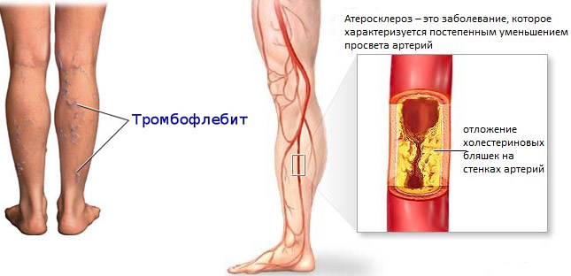Симптомы нарушения кровообращения нижних конечностей и способы лечения, меры профилактики Симптомы нарушения кровообращения нижних конечностей и способы лечения, меры профилактики