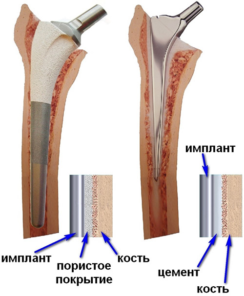 Имплантированный сустав Имплантированный сустав