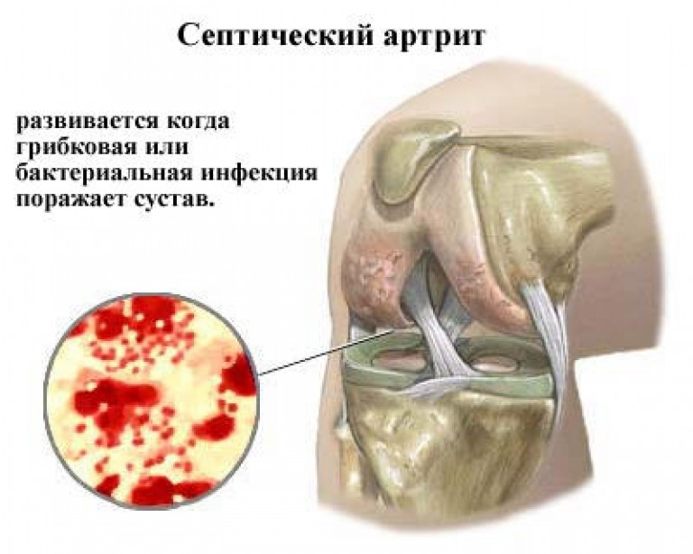 Дистрофия позвоночника как лечить Дистрофия позвоночника как лечить