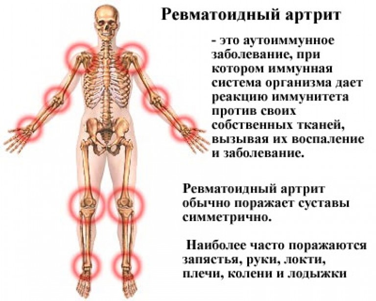 снятие боли при грыже позвоночника медикаментозное снятие боли при грыже позвоночника медикаментозное