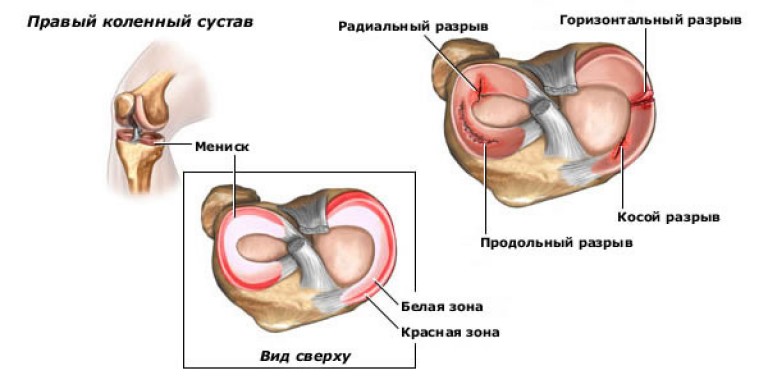 симптомы разрыва заднего рога мениска коленного сустава симптомы разрыва заднего рога мениска коленного сустава