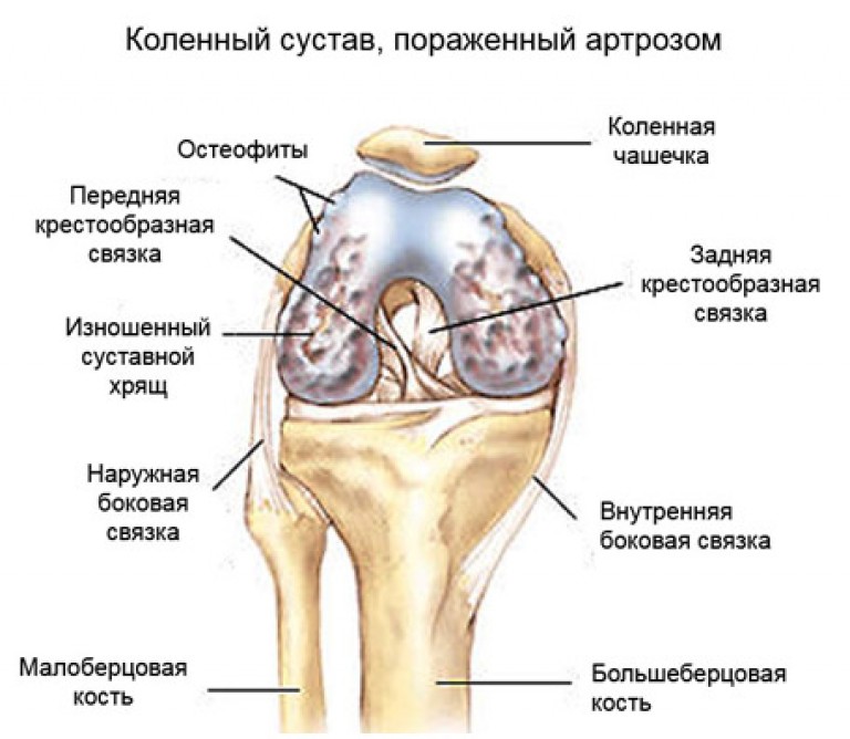 Как лечить гонартроз второй степени 141