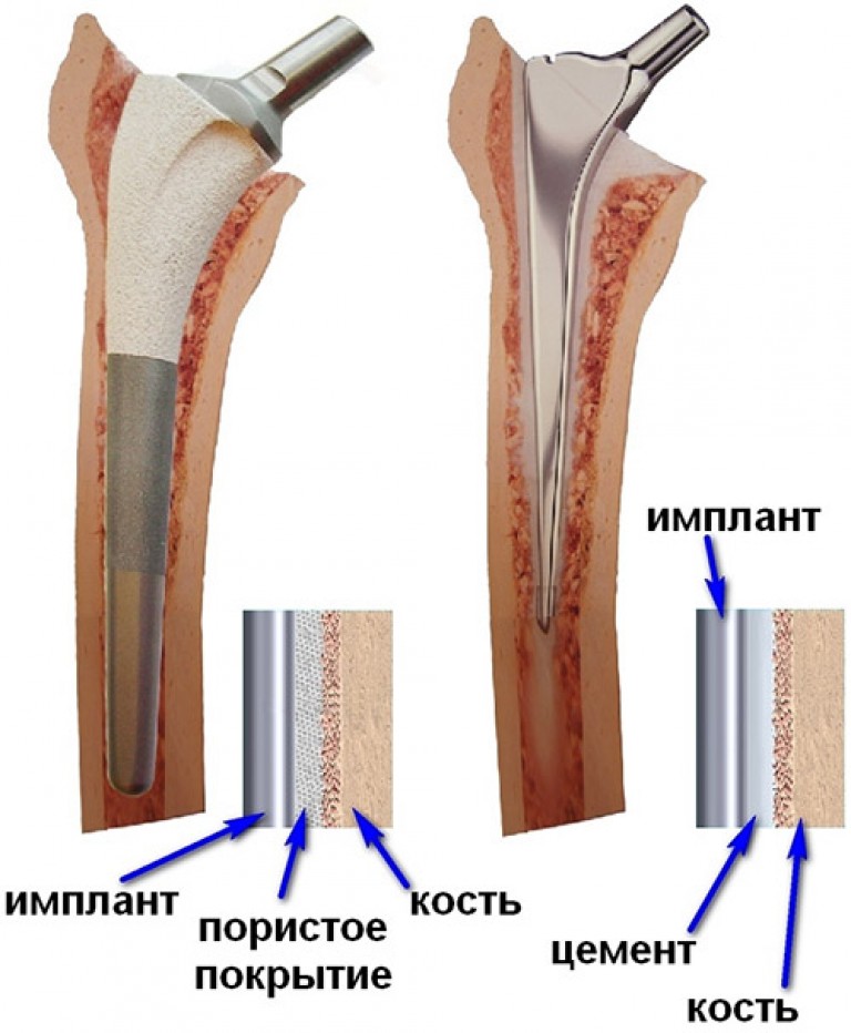 эндопротез крупных суставов цементна эндопротез крупных суставов цементна