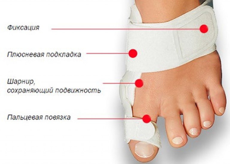 Тейпирование вальгусной деформации большого пальца стопы схема