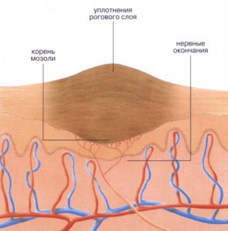 Нервная кожа. Стержневая мозоль внутри строение. Строение стержневой мозоли.