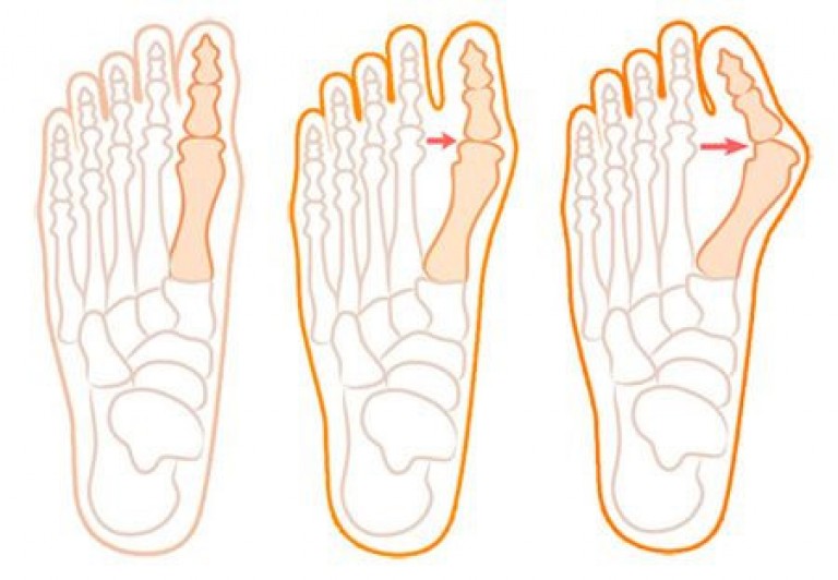 Вальгусная стопа у взрослых операция. Вальгус деформация большого пальца стопы. Вальгус вальгус плоскостопие. Что такое вальгусная деформация 1 пальца на ноге. Плоскостопие вальгусная стопа.