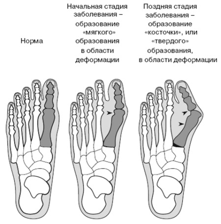 Деформация сустава ноги