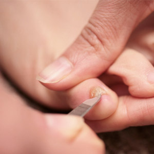Как при помощи перекиси водорода вылечить запущенный грибок на ногтях