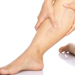 Какие венотоники применяются при варикозной болезни ног