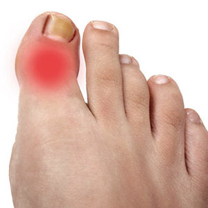 Лечение воспалительных процессов в суставе большого пальца ноги