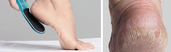 Повреждение кожи на ступнях