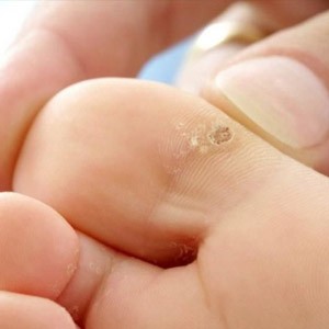Способы удаления сухих мозолей на стопе и пальцах ног