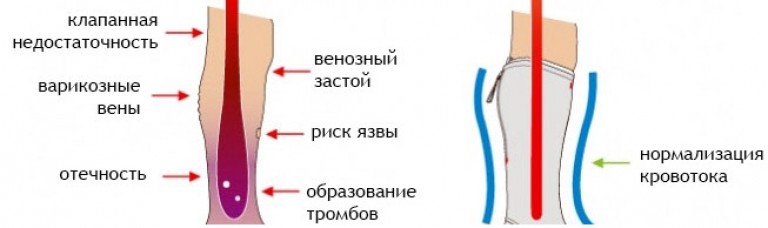 Венозный застой. Принцип действия компрессионных чулок. Компрессионный трикотаж при варикозе вен промежности. Относительная клапанная недостаточность глубоких вен. Механизм действия компрессионного рукава.