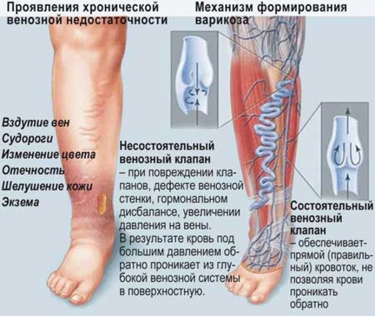 Схема лечения варикоза нижних конечностей