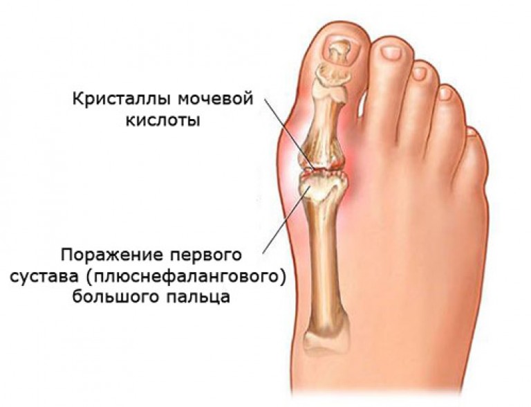 Болит основание сустава большого пальца. Плюснефаланговый сустав подагра. Первый плюснефаланговый сустав подагра. Подагра 1 плюснефалангового сустава. Сустав большого пальца ноги.