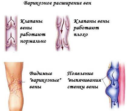 Что такое варикозное расширение вен