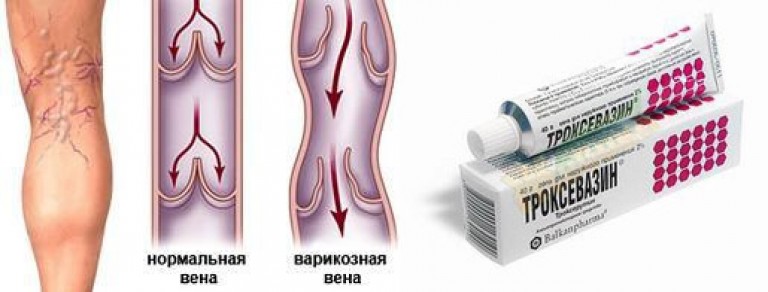 От вен на ногах. Детралекс варикозное расширение вен ног. Детралекс ноги до и после. Детралекс от варикоза до и после.