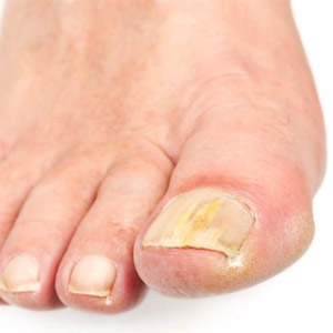Какие препараты помогают вылечить грибок ногтей на ногах