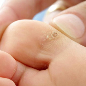 Лечение бородавок на пальцах ног