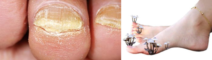 Лечение грибка на ногтевых пластинах