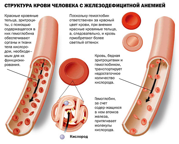 Что такое анемия