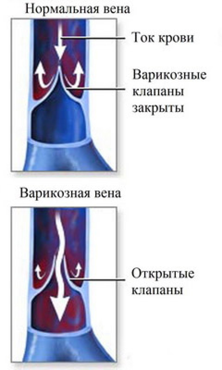 Варикоз малого таза фото